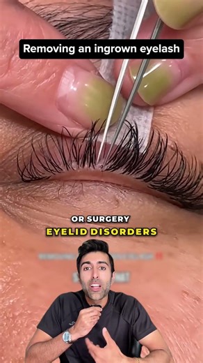 What Happens When an Eyelash Grows the Wrong Way