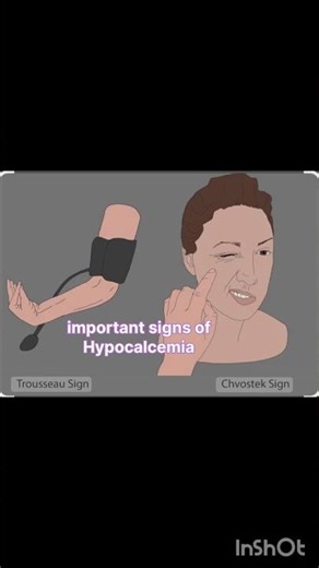 Chvostek and Trousseau signs#hypocalcemia #studyshort