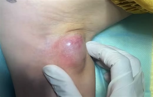Very Old Underarm Abscess Incision and Drainage - New Pimple Popping Videos
