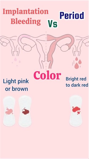 Implantation bleeding Vs period #implantationbleeding