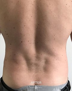 Sculpting Venus Dimples Through Hi-Def Liposuction