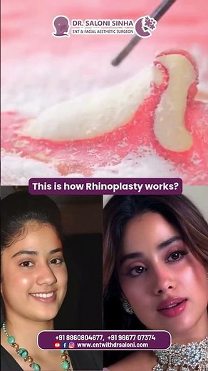 This is how Rhinoplasty works
