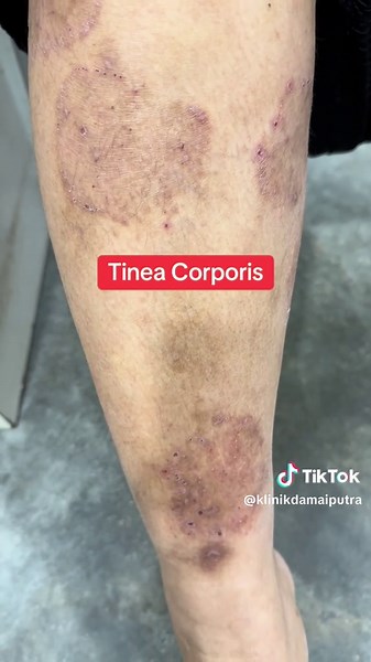 Understanding Tinea Corporis: Symptoms, Causes, and Treatment Options