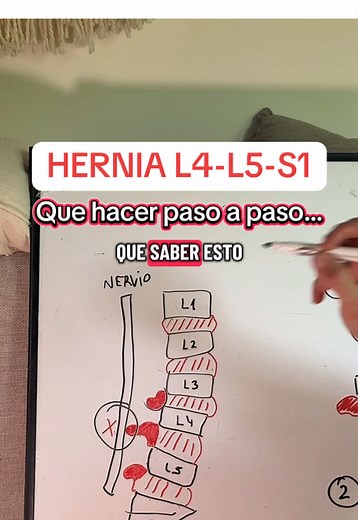 Tratamiento Completo para Hernia Lumbar L4-L5-S1
