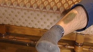 How Do Bruises Form? | Britannica