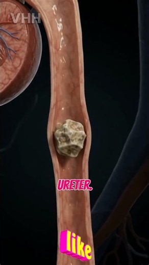 What Happens When a Kidney Stone Moves Through Your Ureter? 🫘 | 3D Anatomy