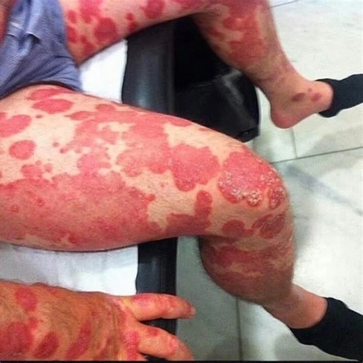 Nurse Chinel on Instagram: "Severe case of psoriasis after the patches have been scraped oft! Psoriasis is a complex immune-mediated disorder that presents as inflammatory plaques in the skin. This multifactorial, inflammatory disease that involves hyperproliferation of the keratinocytes in the epidermis, with an increase in the epidermal cell turnover rate. These skin patches are typically red, dry, itchy, and scaly. On people with darker skin the patches may be purple in color. Psoriasis varie