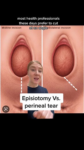 Understanding Episiotomy and Perineal Tear Wounds: Healing Process and Recovery
