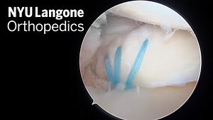 Meniscal Root Repair with Centralization Stitch