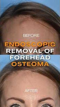 Endoscopic removal of forehead osteoma