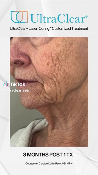 UltraClear Laser: Transform Your Skin Today