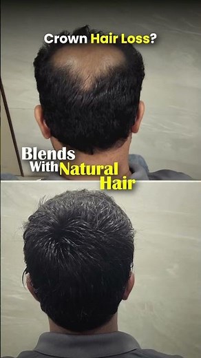 Crown Hair Thinning: Is Your Treatment Really Working ?
