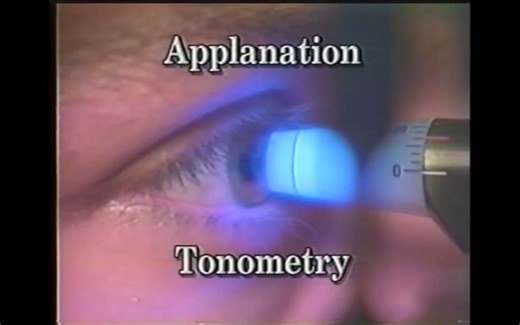 Goldmann Applanation Tonometry Procedure Technique Tutorial - Goldmann压平式眼压计教程