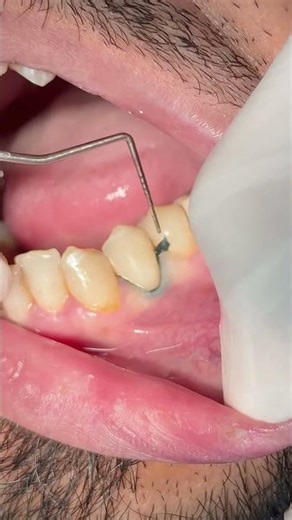 Finishing of class V composite restoration #dentist