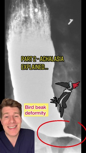 PART 2. ACHALASIA EXPLAINED #meded #doctor #fyp #foryoupage #achalasia #bariumswallow #endoscopia #endoscopy #swallowingdisorders #swallowing #swallowingproblems #health #healthinformation #healtheducation #medicalquiz #medicaleducation #meded @NHS UK