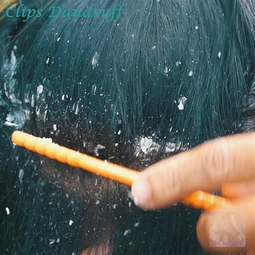 A Complete Guide to Scalp Care for Dandruff Solutions! 411 | Clips Dandruff