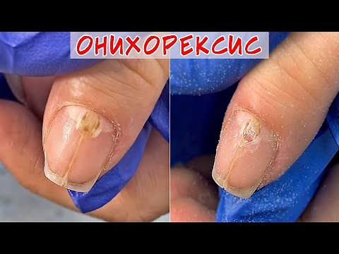 Onychorrhexis Causes and Treatment / Cracked Nail