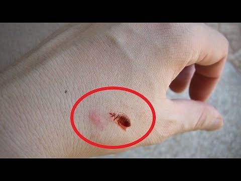 What Do Bed Bug Bites Look Like? Rashes and Symptoms