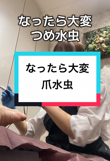 爪水虫の効果的な治療法と対策