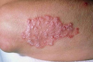 Skin diseases: how to treat psoriasis? | Emergency Live