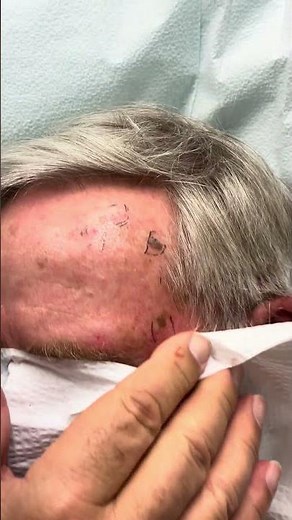 Dr. B Shows Different Spots on Patient's Forehead👨🏻‍⚕️