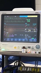 From Elisa Hostetler: "Equine colic. Small colon rupture due with enterolith. Owner elected humane euthanasia under general anesthesia. ECG minutes after euthanized. Pulseless electrical activity remained for about 4 minutes." | I Love Veterinary Medicine
