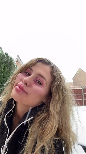 My cast is finally off!! | liana jade i got my cast off