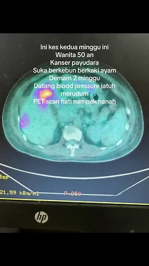 #docalee #dockuman #doclego #liverabscess