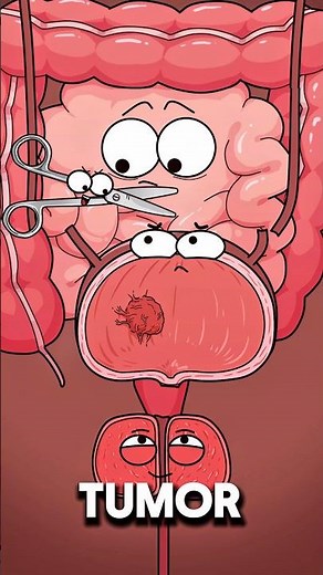 What Happens…..During Bladder Removal Surgery 😱..!!#health #animation #fypシ #3danimation #shorts