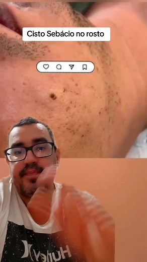 Cisto Sebácio no rosto #cravos #cravononariz #removedordecravos #satisfying #limpezasatisfatoria#cyst #big #abscess #stinks #pue #pimplesolution #blackhead #acne #infected