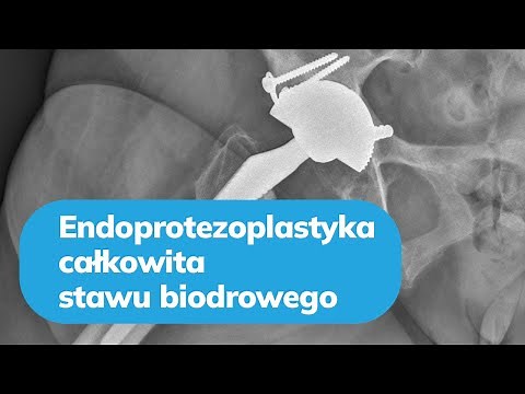 Endoprotezoplastyka całkowita stawu biodrowego - dr hab. n. med. Ireneusz Babiak