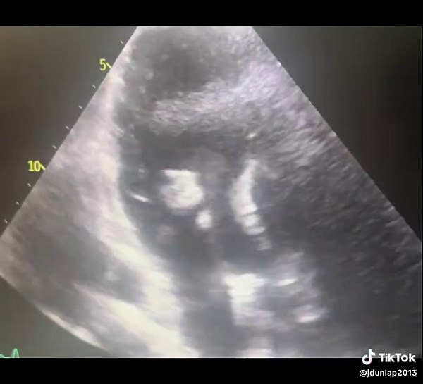 Understanding Infective Endocarditis in IV Drug Users