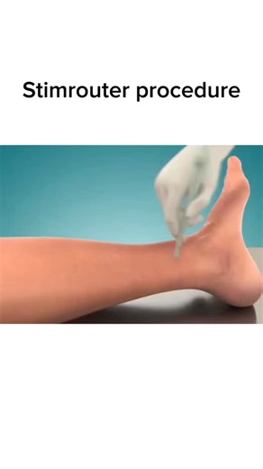 Surgical Animation on Instagram: "Follow @surgicalpovs for more! 🏥"