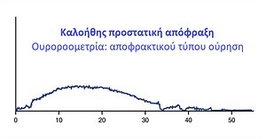 Καλοήθης προστατική απόφραξη: η συχνότερη αιτία αποφρακτικής ούρησης στους άνδρες - Ιωάννης Μπουζαλάς Χειρουργός Ουρολόγος Ανδρολόγος