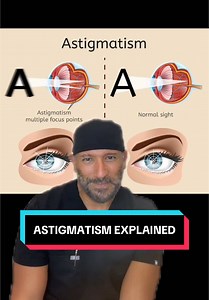 Understanding Astigmatism: Causes and Solutions
