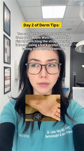 Dr. Linda Xing | Dermatologist & Skin Surgeon on Instagram: "Sadly once you are allergic, it’s forever 😢 Nickel allergy is one of the most common reasons I see itchy rashes from jewelry and everyday metal. If the rash matches exactly where your watch, earrings, or belt sits, nickel is often the culprit. Avoiding the trigger is the real treatment! #skinallergy #nickelallergy #contactdermatitis #metalallergy #dermatologist"