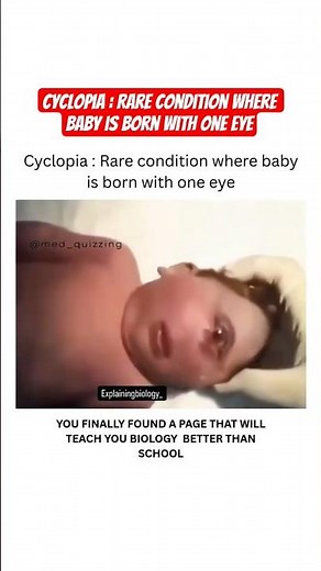 Cyclopia : Rare Condition where Baby is Born with One Eye