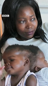 1.8M views · 1.8K shares | After 18 hours of one one hard surgery, doctors for Italy's Bambino Gesu hospital don separate two-year-old conjoined twins, Ervina and Prefina. | BBC News Pidgin | Facebook