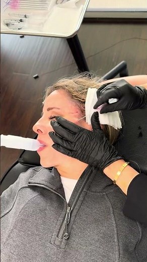 PDO Thread Lift: Your Non-Surgical Facelift Solution! 💫