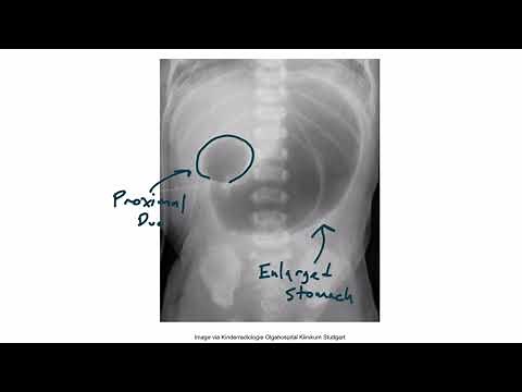 Gastrointestinal Embryology Section 4 Intestinal Atresia –