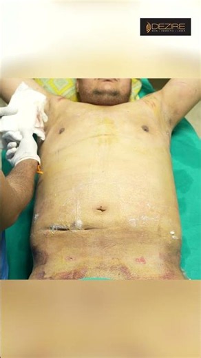 360 Abdomen Liposuction & Gynecomastia Dressing , RF Session
