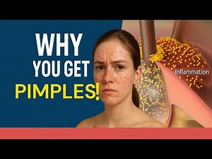 Acne Explained for USMLE & NEET PG | Pathophysiology, Types & Treatment of Pimples