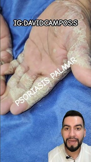 TIENE PSORIASIS EN LAS MANOS