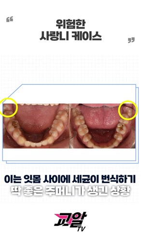 사랑니 관상🕵️‍♂️ 뽑아야 할 사랑니의 결정적 기준!