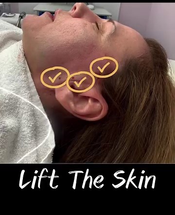 Threadlifts offer a highly effective, non-invasive solution for...