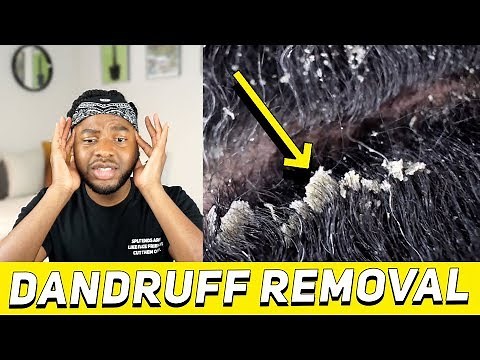 REACTING TO EXTREME DANDRUFF SCRATCHING AND REMOVAL (and tips for dry, flakey scalp!)
