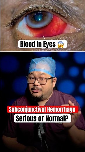 Blood in Eye with blurry vision and Irritation 😱 #eyeproblems #eyehealth #facts #viralshorts