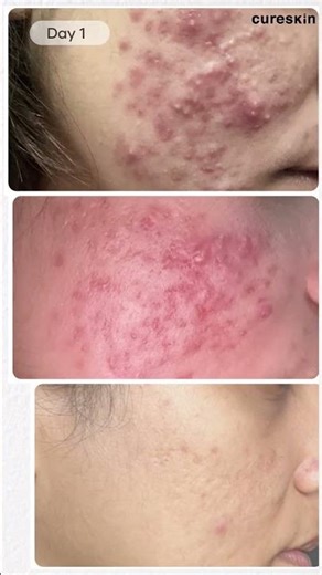 Acne for 1 Year… Cleared in 1 Month | Cureskin Treatment Review
