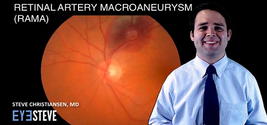 Retinal Artery Macroaneurysm (RAMA) - EyeSteve.com