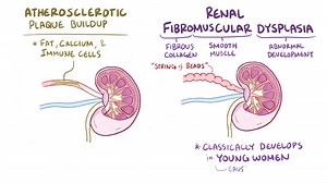 File:Renal artery stenosis.webm - Wikimedia Commons